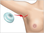 豊胸手術（プロテーゼ挿入法）