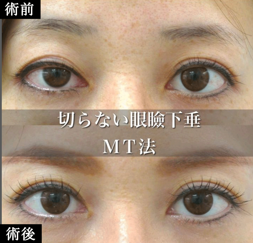切らない眼瞼下垂治療 MT法　症例写真3