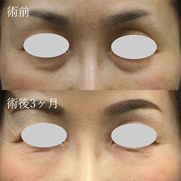 マフトガンによる脂肪移植(脂肪注入)