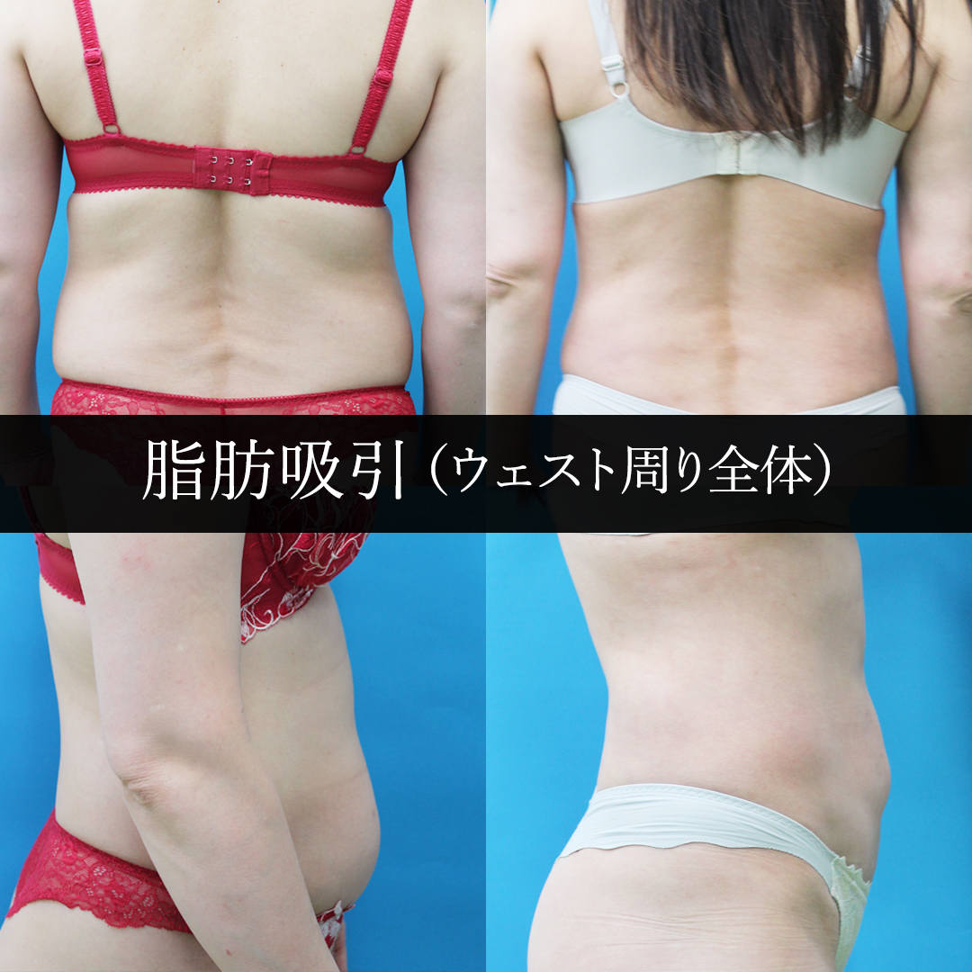 脂肪吸引(ウェスト周り全体)