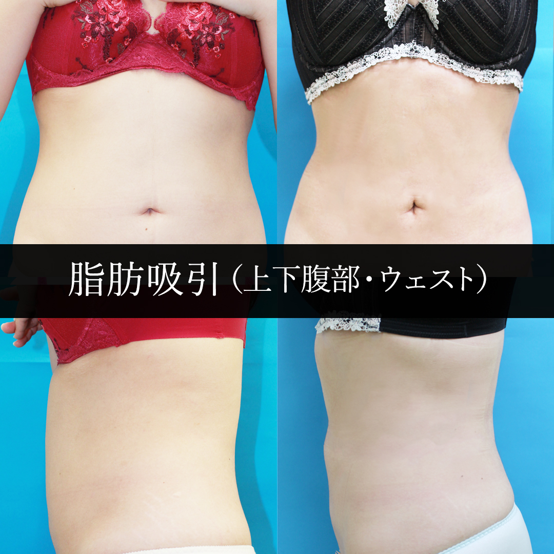 脂肪吸引（上下腹部・ウェスト周り全体）