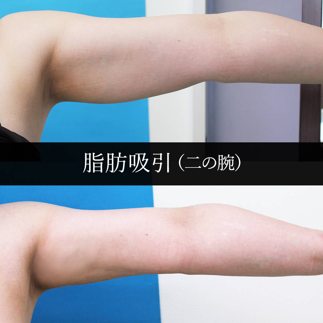 脂肪吸引（二の腕）